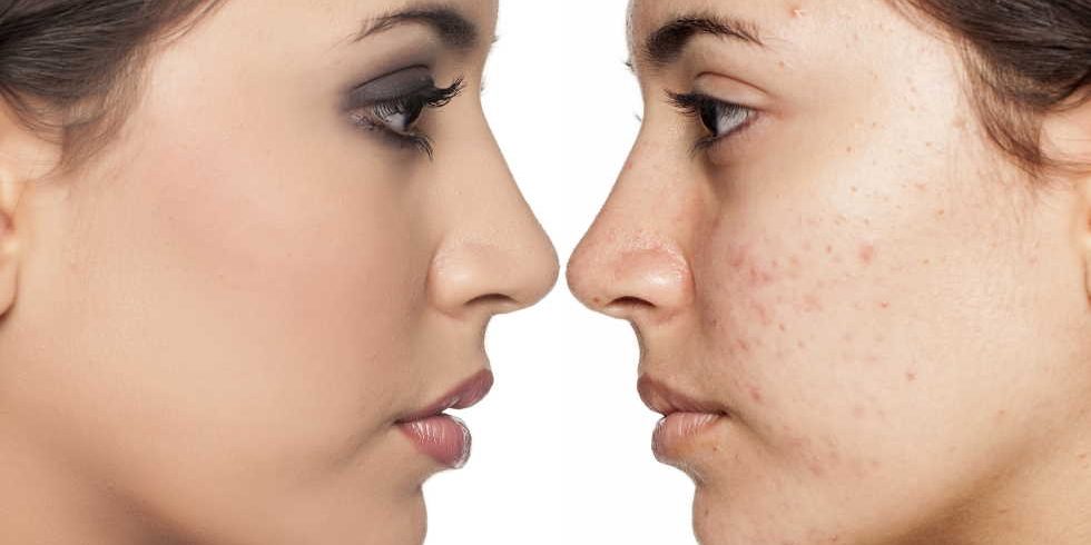 8239563 get rid of acne scars